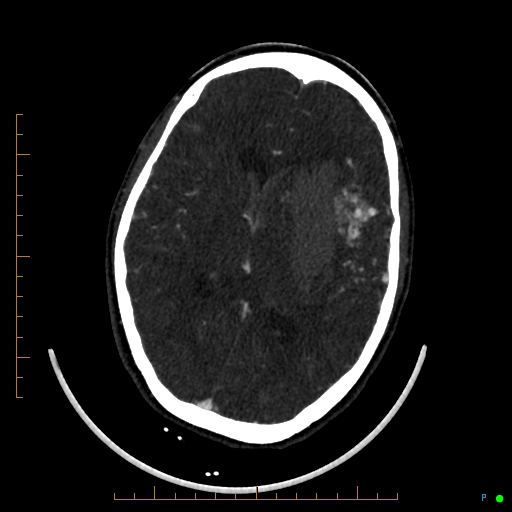 Cerebral arteriovenous malformation (AVM) (Radiopaedia 78162-90706 Axial CTA 157).jpg