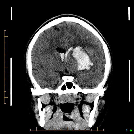 File:Cerebral arteriovenous malformation (AVM) (Radiopaedia 78162-90706 Coronal non-contrast 44).jpg