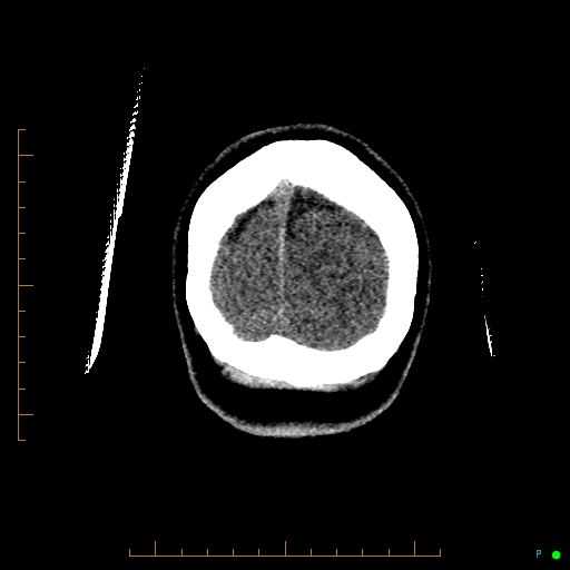 File:Cerebral arteriovenous malformation (AVM) (Radiopaedia 78162-90706 Coronal non-contrast 92).jpg