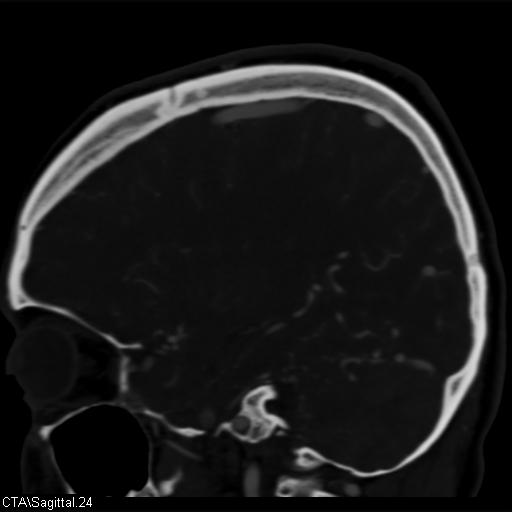 Cerebral arteriovenous malformation (Radiopaedia 28518-28759 D 21).jpg