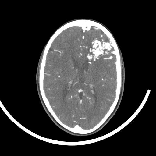 Cerebral arteriovenous malformation (Radiopaedia 29531-30031 E 35).jpg