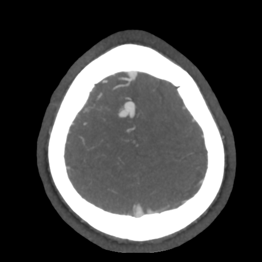 Cerebral arteriovenous malformation (Radiopaedia 39259-41505 AX CEREBRAL CTA 49).png