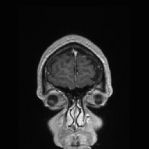Cerebral arteriovenous malformation (Radiopaedia 39259-41506 Coronal T1 C+ 87).png