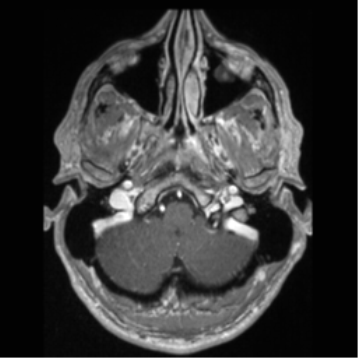 Cerebral arteriovenous malformation (Radiopaedia 55798-62372 Axial T1 C+ 10).png