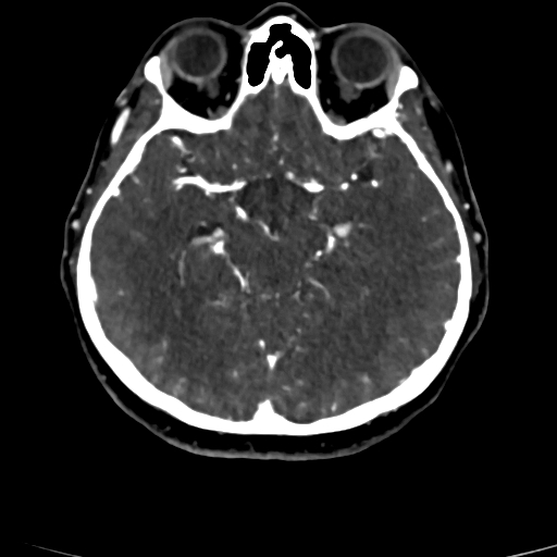 Cerebral arteriovenous malformation (Radiopaedia 73830-84645 Axial C+ delayed 55).jpg