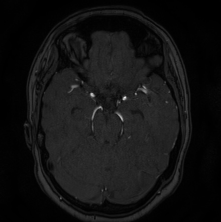 Cerebral arteriovenous malformation (Radiopaedia 74411-85654 Axial MRA 44).jpg