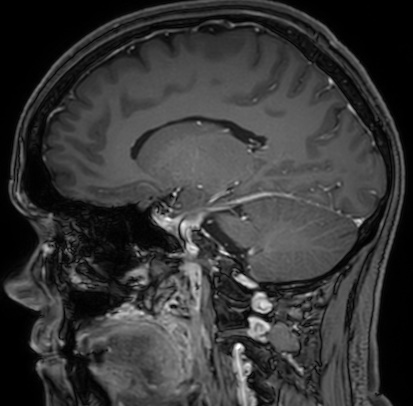 Cerebral arteriovenous malformation (Radiopaedia 74411-85654 Sagittal T1 C+ 53).jpg