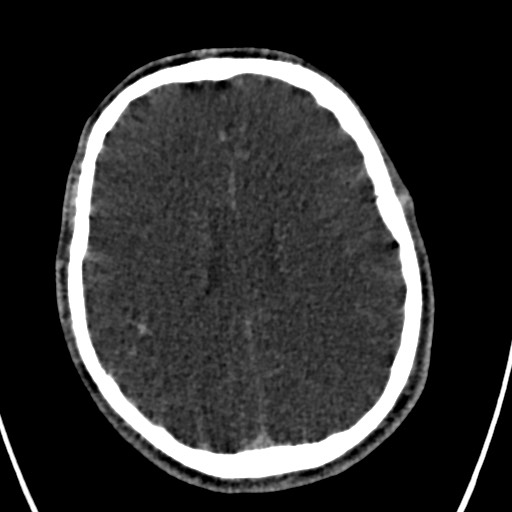 Cerebral arteriovenous malformation (Radiopaedia 78188-90746 Axial C+ delayed 112).jpg