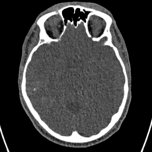 Cerebral arteriovenous malformation (Radiopaedia 78188-90746 Axial non-contrast 70).jpg