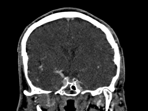 File:Cerebral arteriovenous malformation (Radiopaedia 78188-90746 Coronal C+ delayed 51).jpg