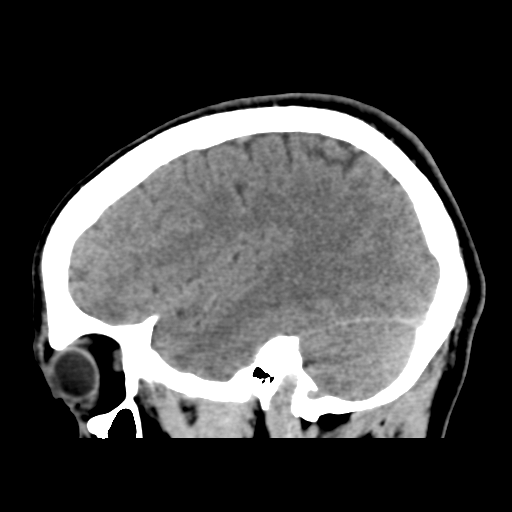 Cerebral arteriovenous malformation (Spetzler-Martin grade 2) (Radiopaedia 41262-44076 A 20).png