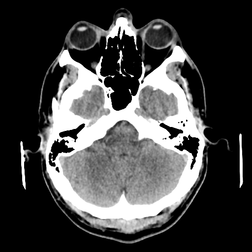 File:Cerebral arteriovenous malformation (Spetzler-Martin grade 2) (Radiopaedia 41262-44076 Axial non-contrast 14).png