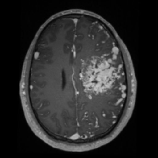Cerebral arteriovenous malformation - huge (Radiopaedia 35734-37272 Axial T1 C+ 48).png