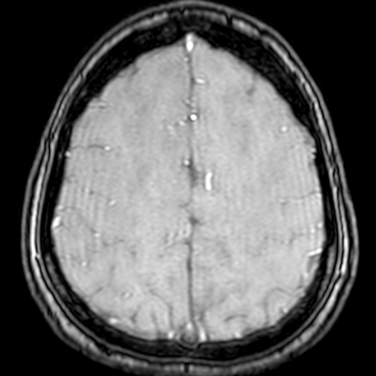 Cerebral arteriovenous malformation at posterior body of corpus callosum (Radiopaedia 74111-84925 Axial MRA 176).jpg