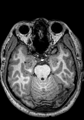 File:Cerebral arteriovenous malformation at posterior body of corpus callosum (Radiopaedia 74111-84925 Axial T1 205).jpg