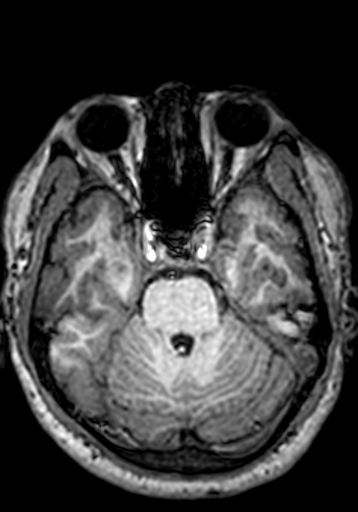 Cerebral arteriovenous malformation at posterior body of corpus callosum (Radiopaedia 74111-84925 Axial T1 217).jpg