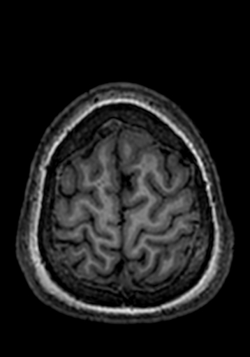 File:Cerebral arteriovenous malformation at posterior body of corpus callosum (Radiopaedia 74111-84925 Axial T1 24).jpg