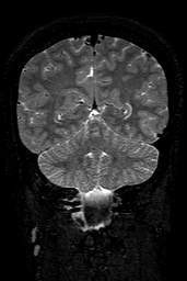 Cerebral arteriovenous malformation at posterior body of corpus callosum (Radiopaedia 74111-84925 Coronal T2 131).jpg