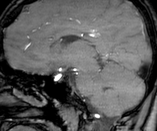 Cerebral arteriovenous malformation at posterior body of corpus callosum (Radiopaedia 74111-84925 J 174).jpg