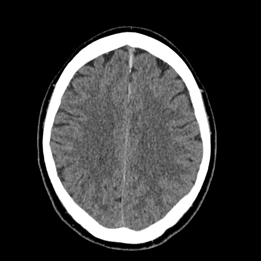 Cerebral arteriovenous malformation with lobar hemorrhage (Radiopaedia 35598-37117 Axial non-contrast 38).jpg