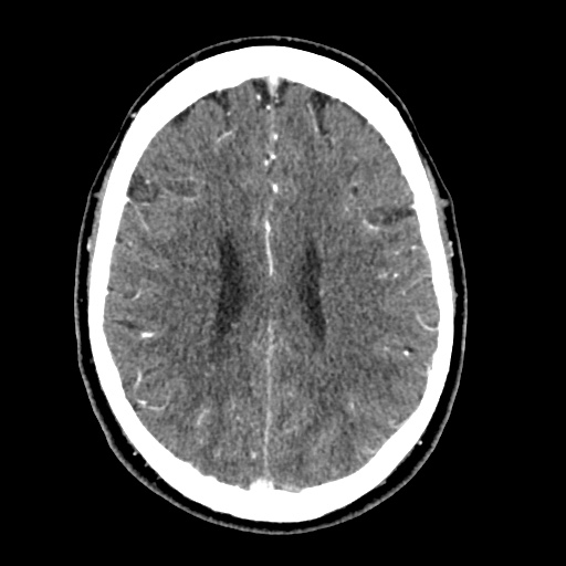 Cerebral arteriovenous malformation with lobar hemorrhage (Radiopaedia 35598-57216 A 41).jpg