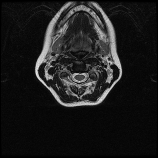 File:Cerebral autosomal dominant arteriopathy with subcortical infarcts and leukoencephalopathy (CADASIL) (Radiopaedia 41018-43763 Ax T2 C2-T1 33).png