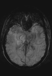 File:Cerebral cavernoma and development venous anomaly (Radiopaedia 37603-39482 Axial SWI MIP 16).png