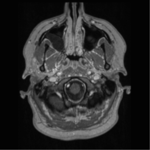 Cerebral cavernoma and development venous anomaly (Radiopaedia 37603-39482 Axial T1 C+ 9).png