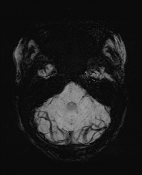 Cerebral cavernous venous malformation (Radiopaedia 70008-80021 Axial SWI 16).jpg