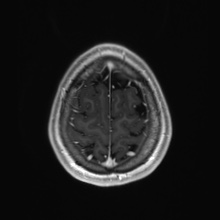Cerebral cavernous venous malformation (Radiopaedia 70008-80021 Axial T1 C+ 91).jpg