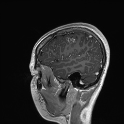 File:Cerebral cavernous venous malformation (Radiopaedia 70008-80021 Sagittal T1 C+ 13).jpg