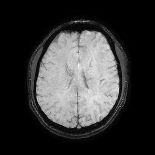 File:Cerebral cavernous venous malformation (Zabramski type II) (Radiopaedia 85511-101198 Axial SWI 78).jpg