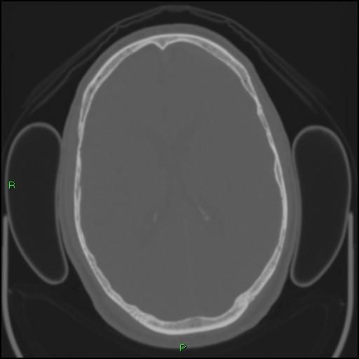 Cerebral contusions (Radiopaedia 33868-35039 Axial bone window 123).jpg