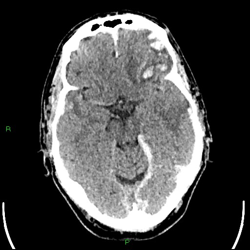 File:Cerebral contusions (Radiopaedia 33868-35039 Axial non-contrast 79).jpg