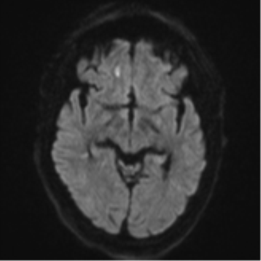 Cerebral embolic infarcts (embolic shower) (Radiopaedia 57395-64342 Axial DWI 52).png
