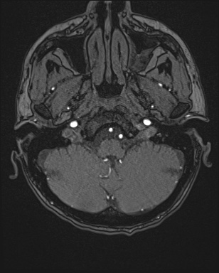 Cerebral embolic infarcts (embolic shower) (Radiopaedia 72391-82921 Axial MRA 5).jpg
