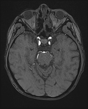 Cerebral embolic infarcts (embolic shower) (Radiopaedia 72391-82921 Axial MRA 55).jpg