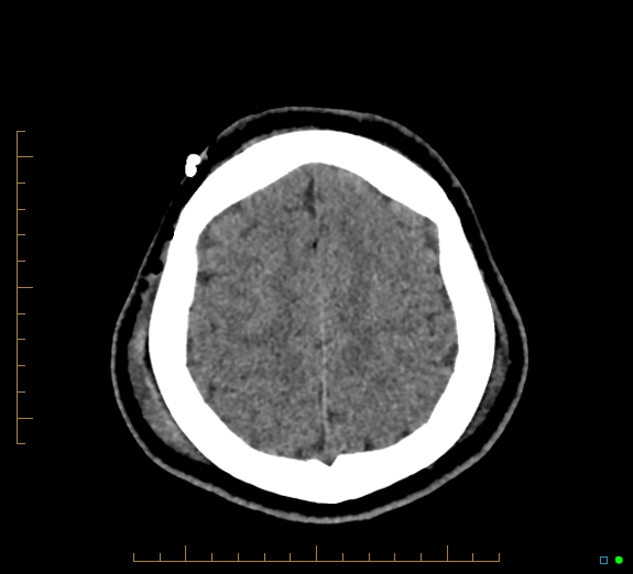 Cerebral fat embolism (Radiopaedia 85521-101224 Axial non-contrast 42).jpg