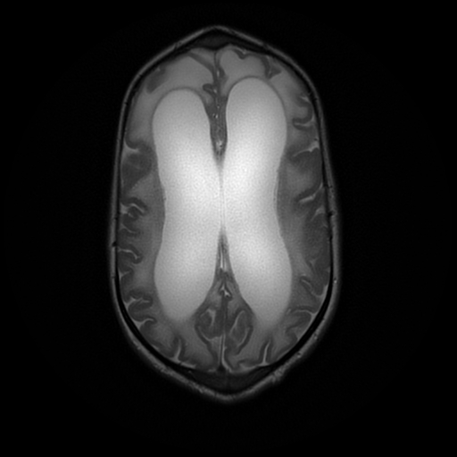 File:Cerebral manifestations of mucopolysaccharidosis type I (Radiopaedia 59171-66487 Axial T2 15).jpg