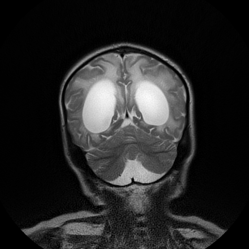 File:Cerebral manifestations of mucopolysaccharidosis type I (Radiopaedia 59171-66487 Coronal T2 17).jpg