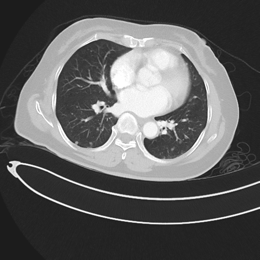 Cerebral metastases (Radiopaedia 33041-34055 Axial lung window 32).png