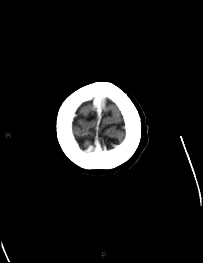Cerebral metastases - ependymal and parenchymal (Radiopaedia 79877-93131 Axial C+ delayed 81).jpg