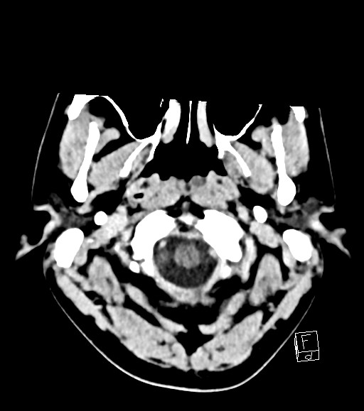 Cerebral metastases - testicular choriocarcinoma (Radiopaedia 84486-99855 Axial C+ delayed 51).jpg