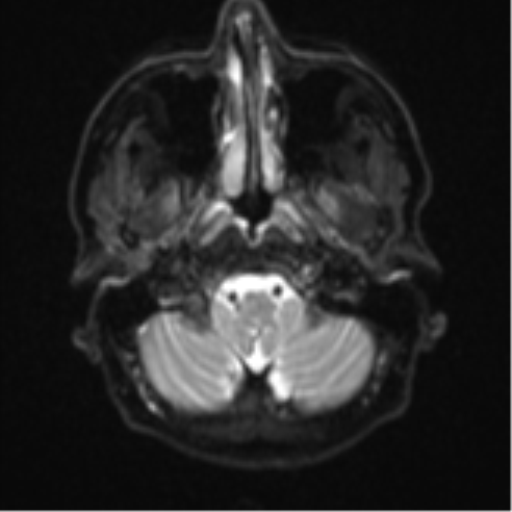 Cerebral metastasis - colorectal adenocarcinoma (Radiopaedia 50394-55765 Axial DWI 2).png