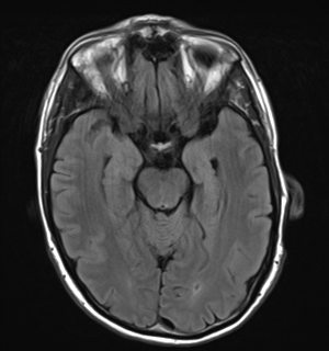 File:Cerebral metastasis - melanoma (Radiopaedia 54718-60954 Axial FLAIR 12).png