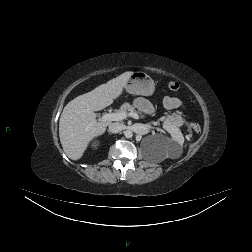 Cerebral metastasis from renal cell carcinoma (Radiopaedia 82306-96378 A 61).jpg
