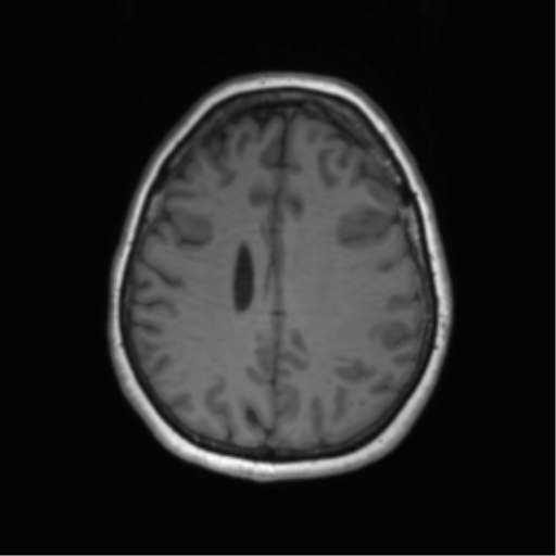 Cerebral metastasis mimicking glioblastoma (Radiopaedia 69155-78937 Axial T1 47).png
