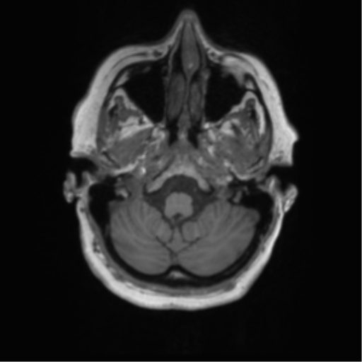 Cerebral metastasis mimicking glioblastoma (Radiopaedia 69155-78937 Axial T1 6).png