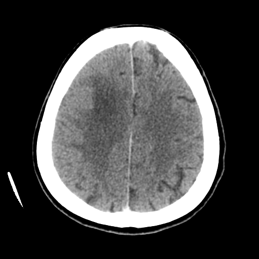 Cerebral metastasis to basal ganglia (Radiopaedia 81568-95412 Axial C+ delayed 43).png