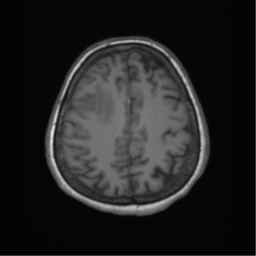 Cerebral metastasis to basal ganglia (Radiopaedia 81568-95413 Axial T1 56).png